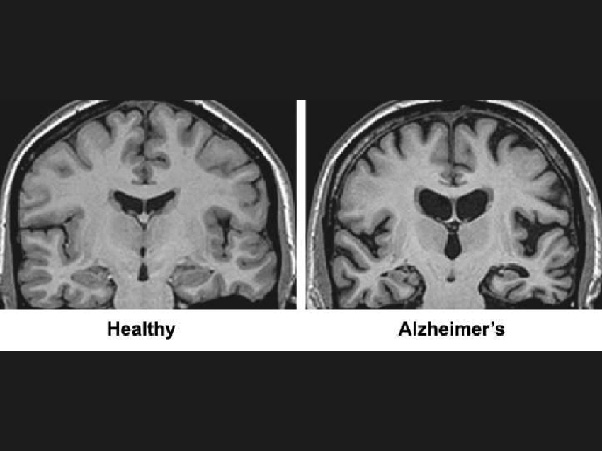 MRI Healthy and Alzheimer Brain Comparison
